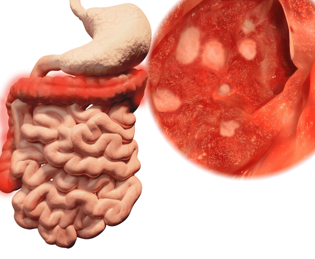 ibd_patients_managing_crohns_ulcerative_colitis